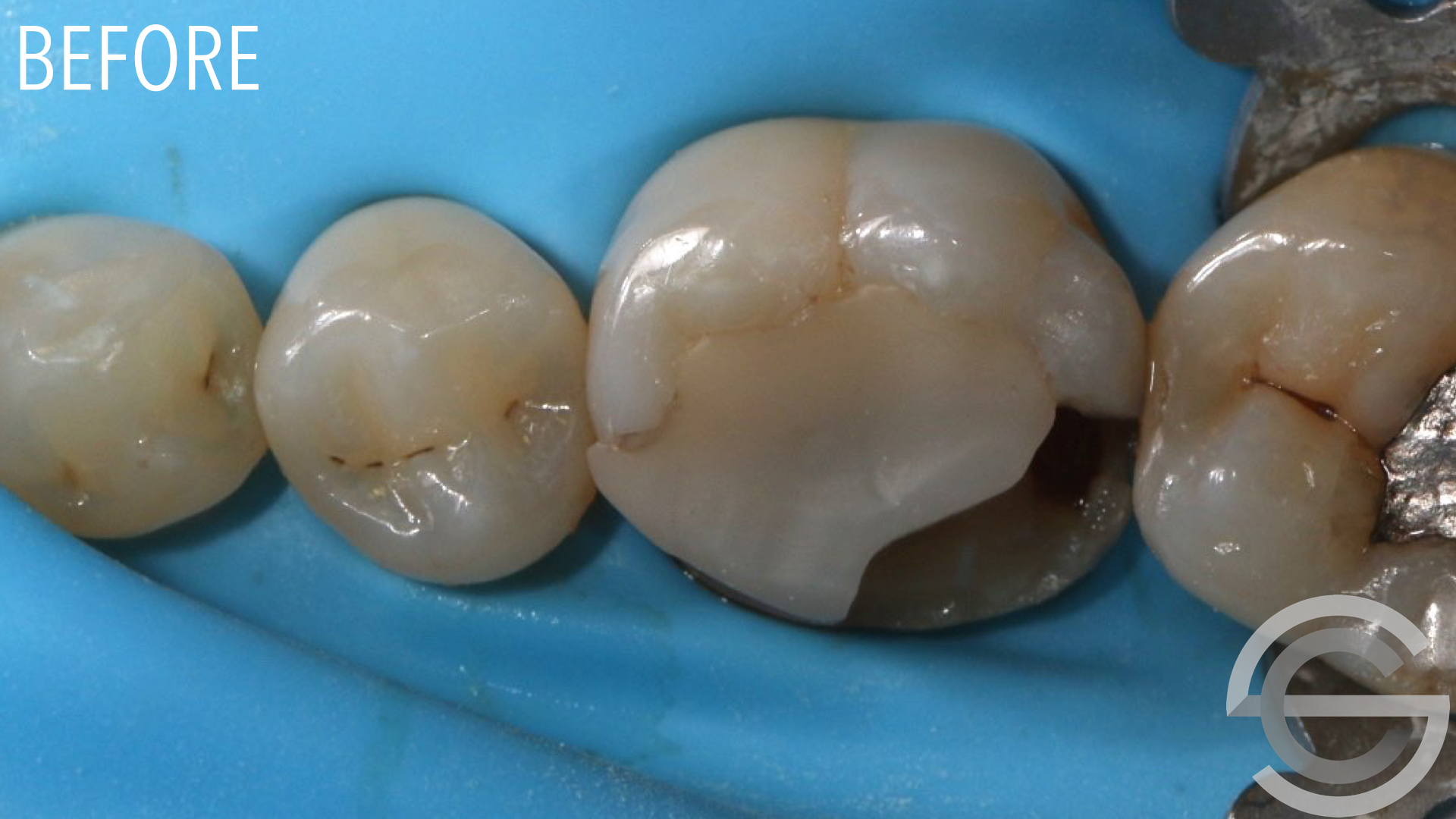 transformation brfore