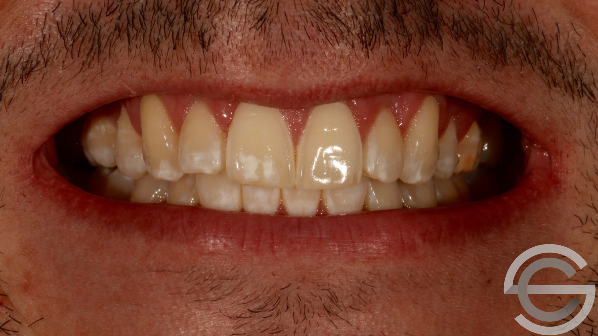 transformation brfore