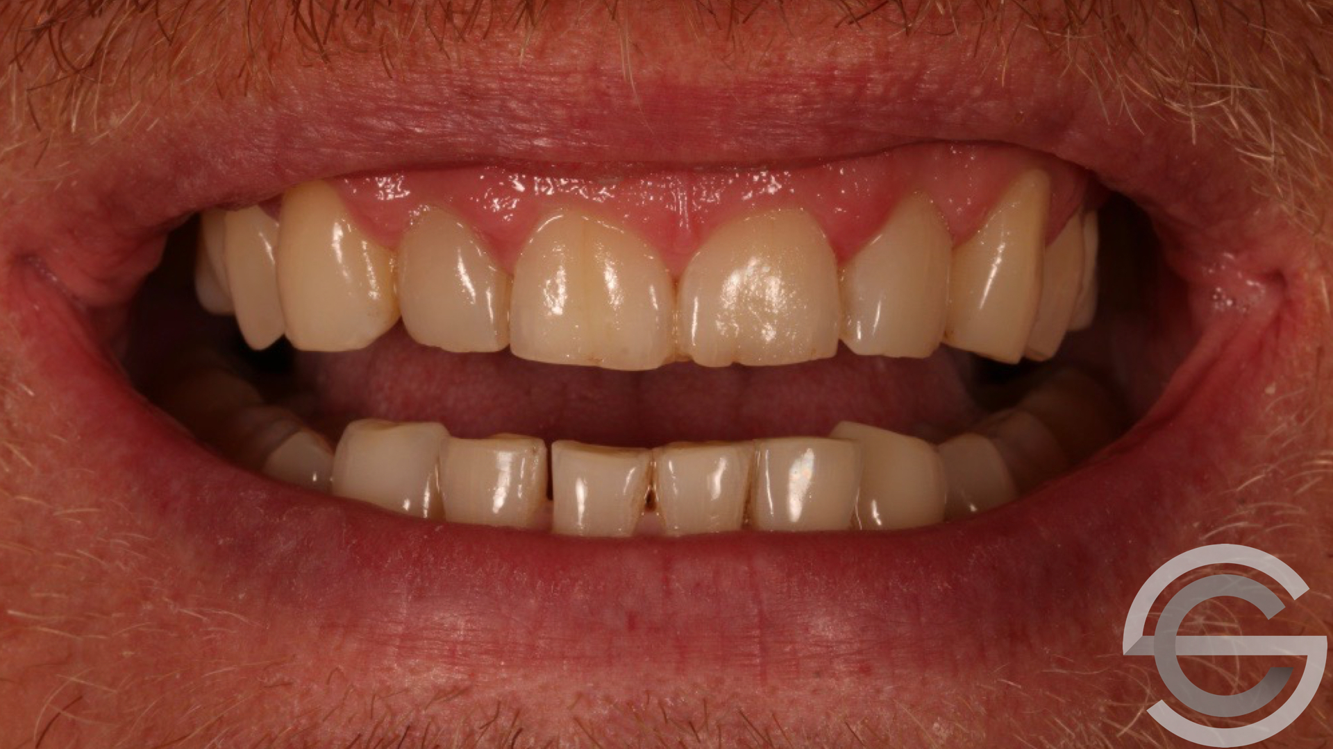 transformation brfore