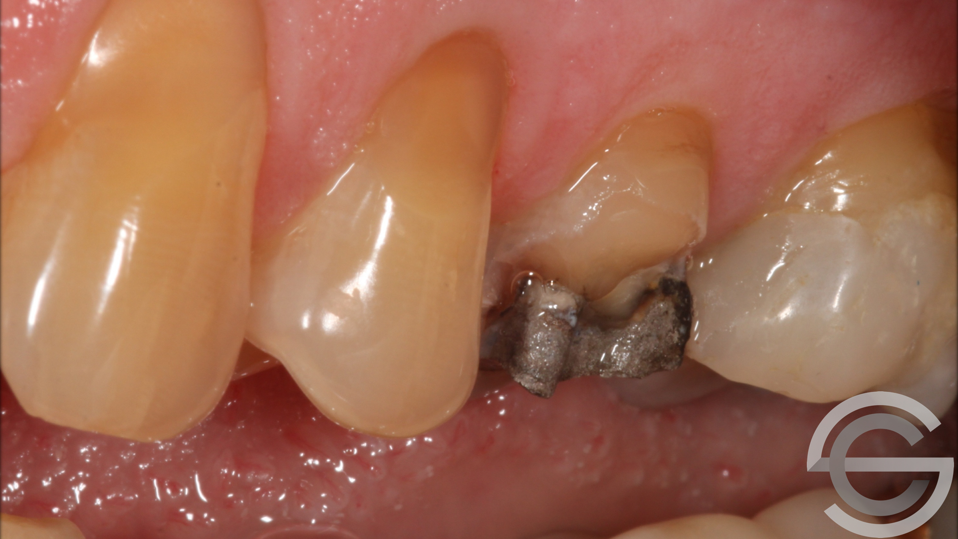 transformation brfore