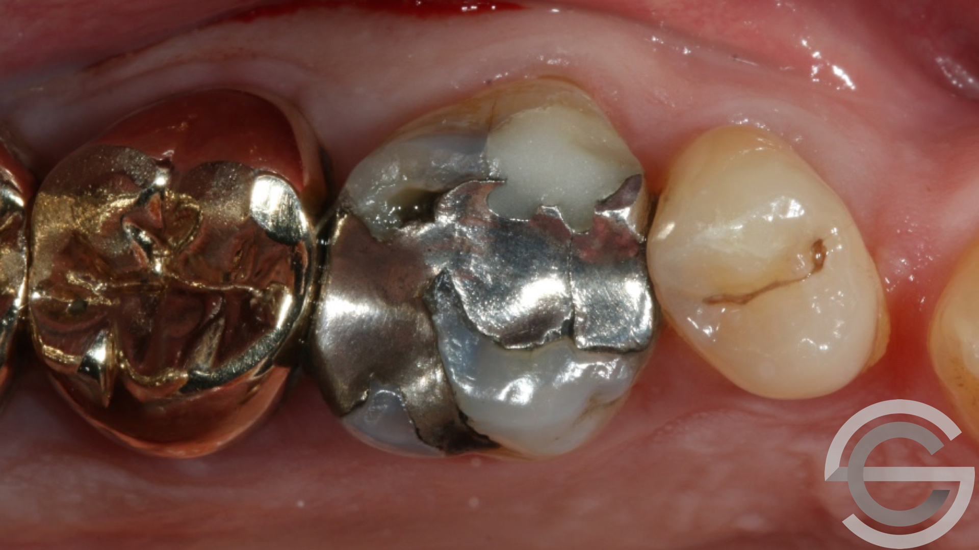 transformation brfore