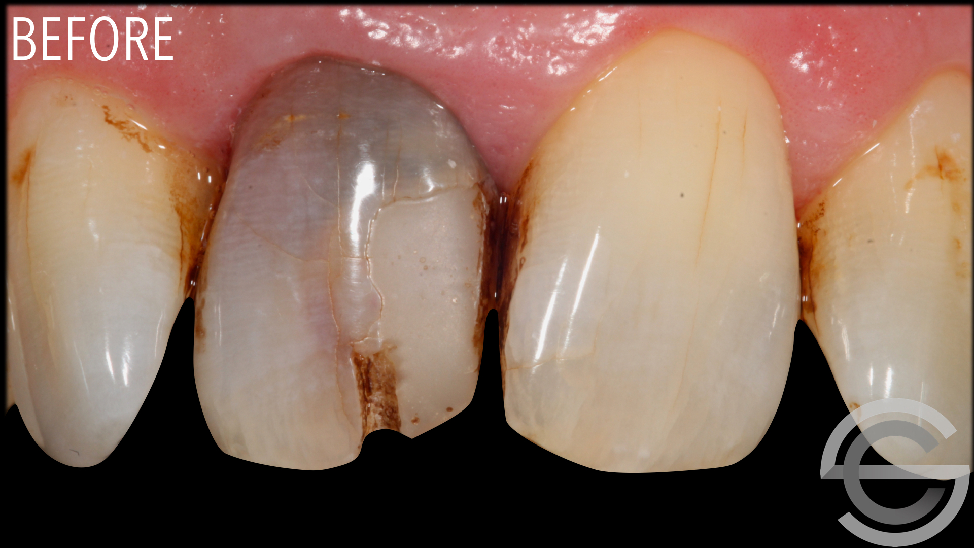 transformation brfore