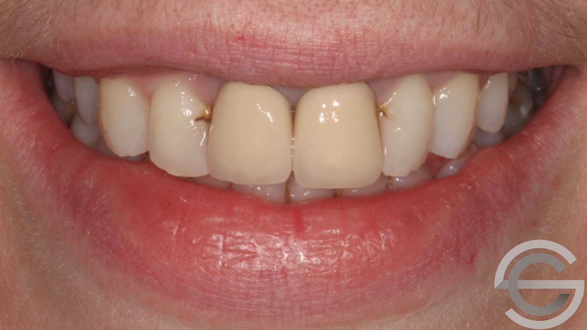 transformation brfore